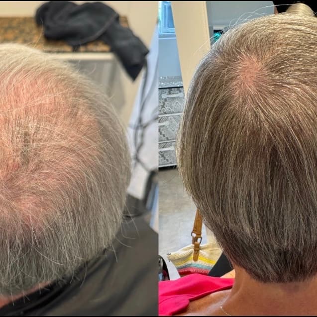 Procell Hair Growth Package at Ocean Waves Med Aesthetics in Oviedo, FL